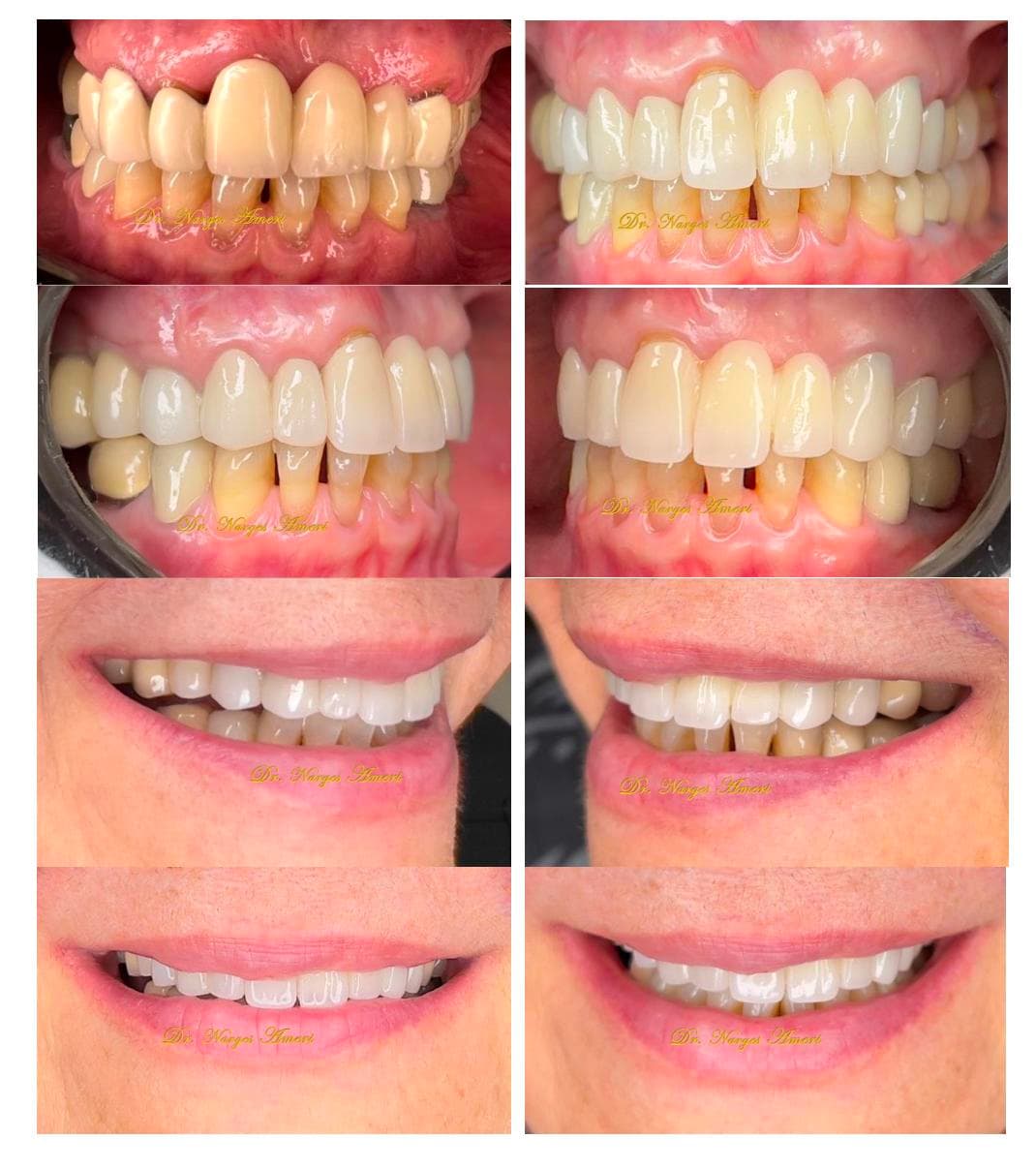 Full-Mouth Rehabilitation - Before and After