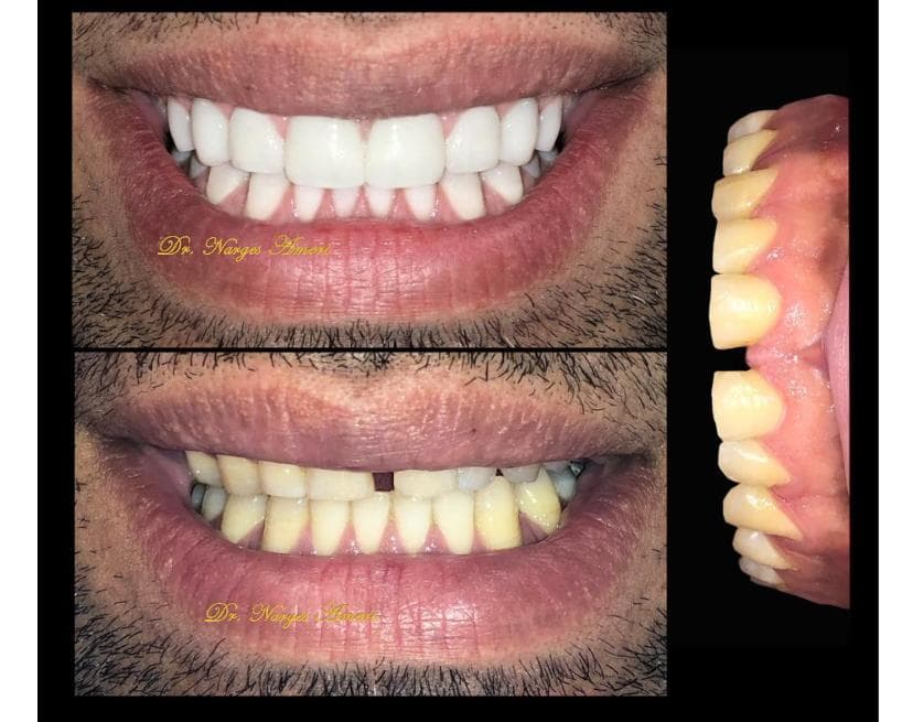 Composite Bonding - Before and After