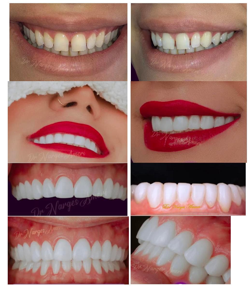 Composite Bonding - Before and After