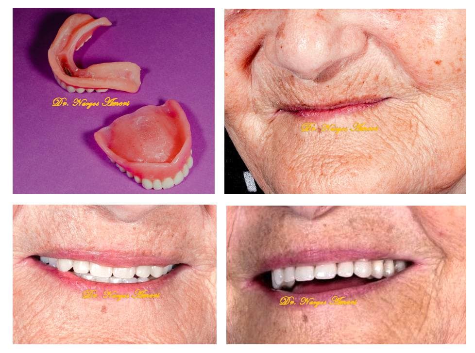 Implant-Supported Overdenture - Before and After