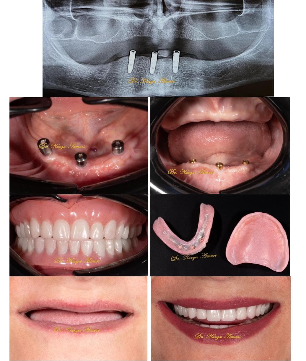 Implant-Supported Overdenture - Before and After