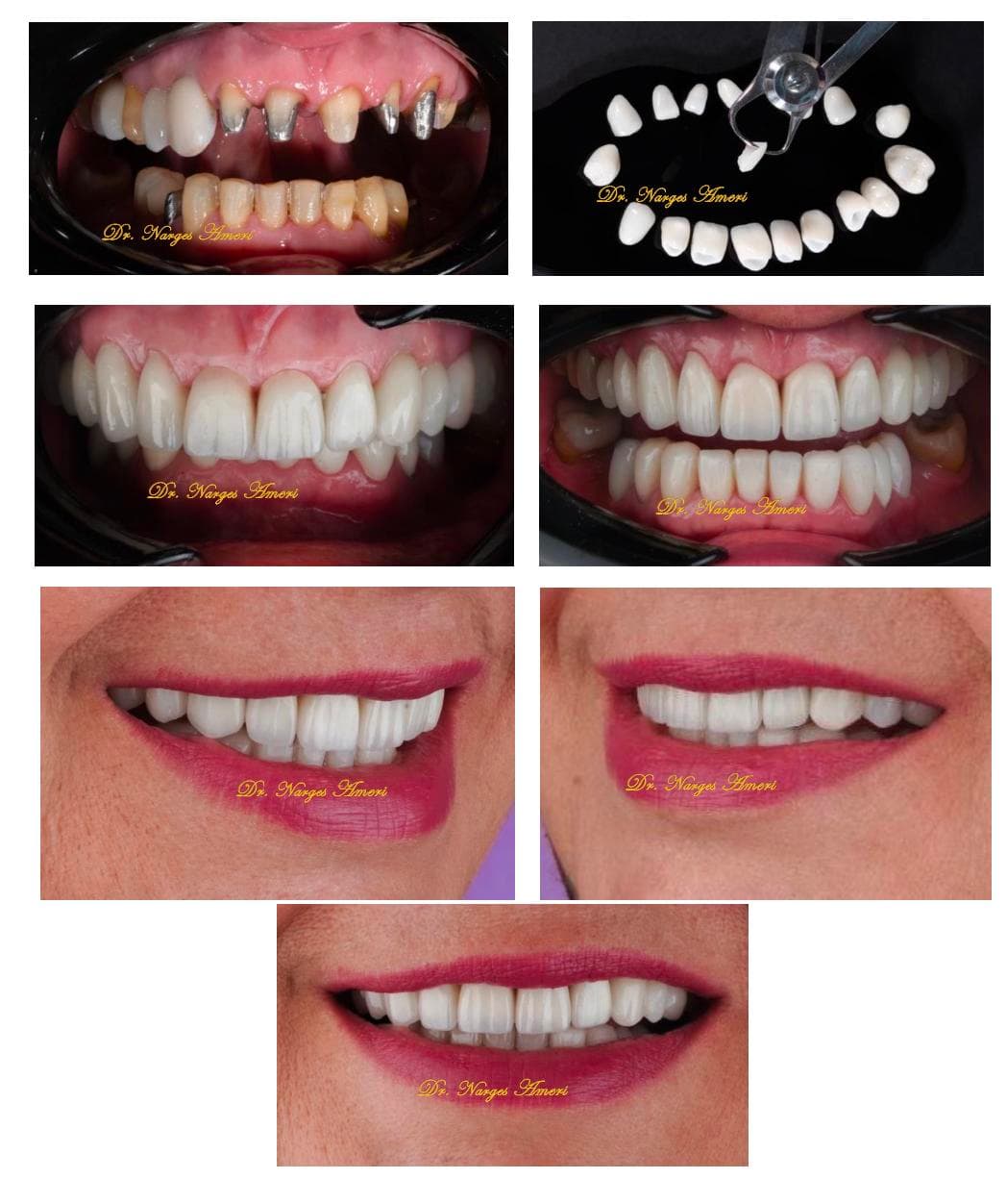 Smile Makeover - Before and After