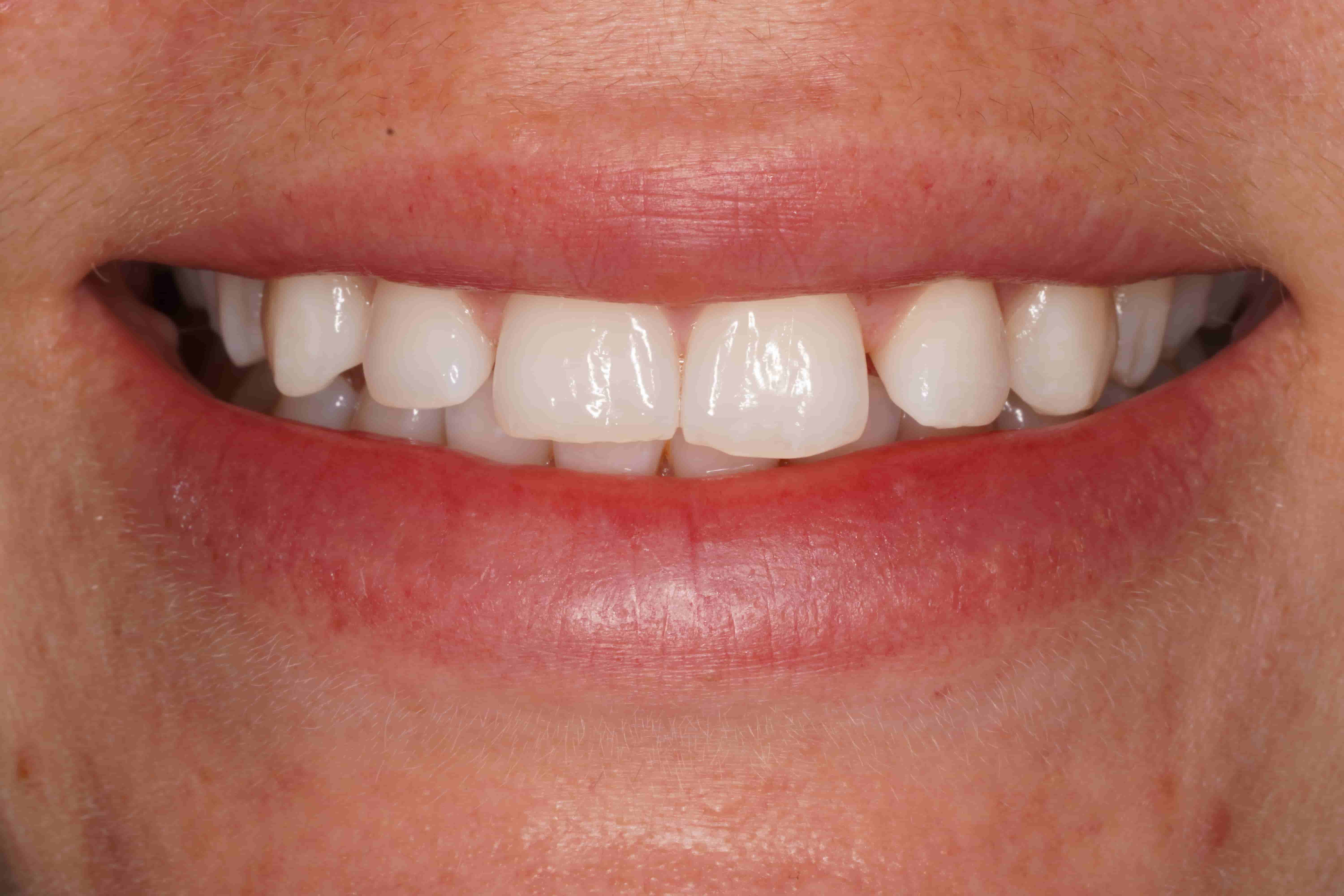 After Teeth Whitening