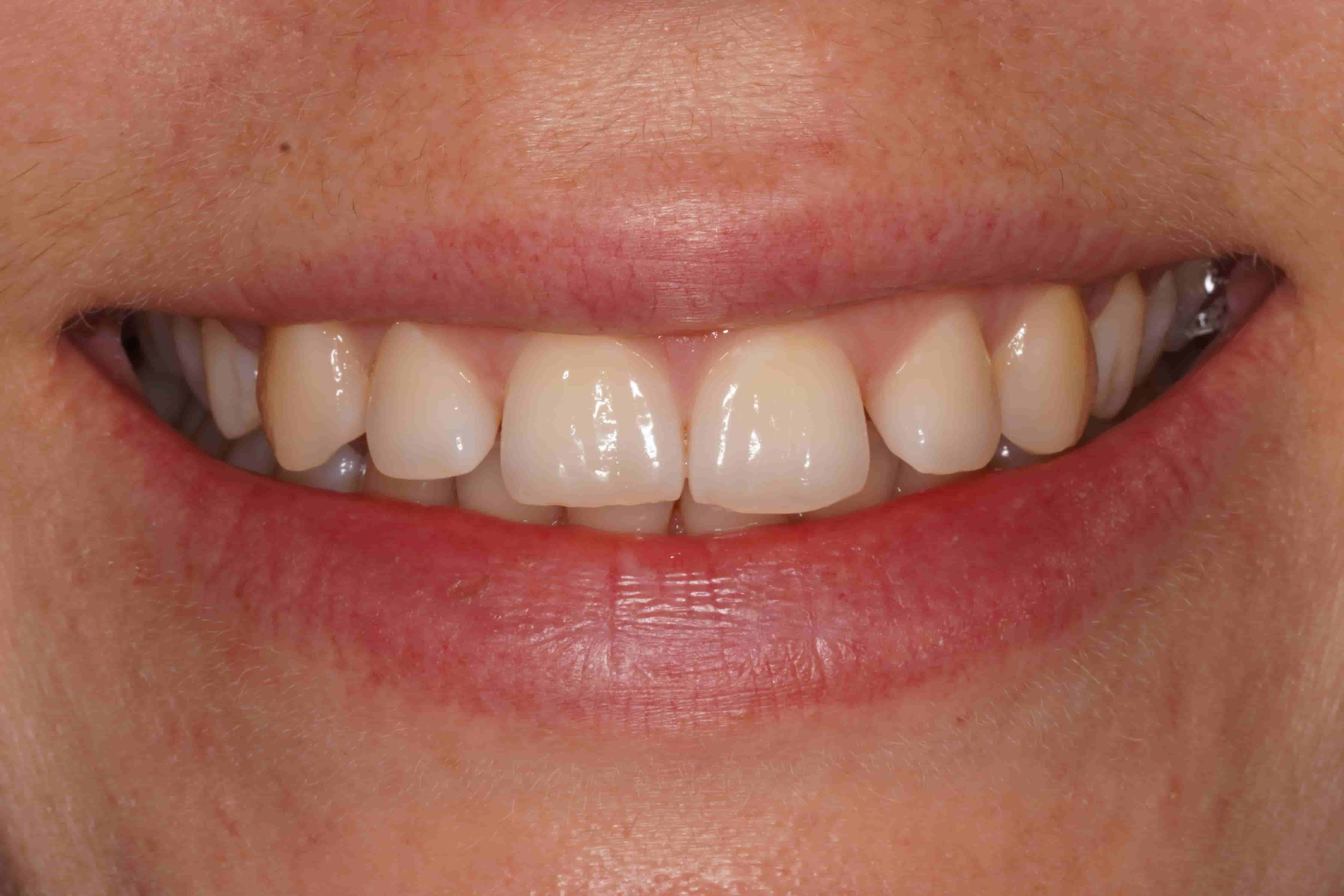 Before Teeth Whitening