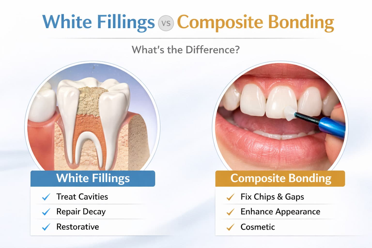 Infographic comparing white fillings and composite bonding \u2014 purpose, preparation, placement, and cosmetic focus