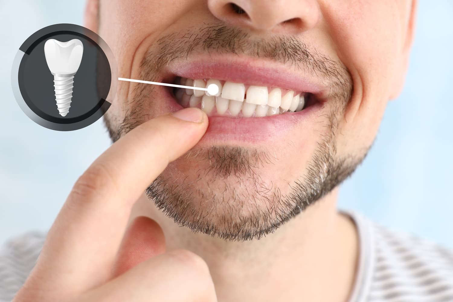 How Long Does Dental Implant Recovery Take? A Week-by-Week Healing Guide for London Patients