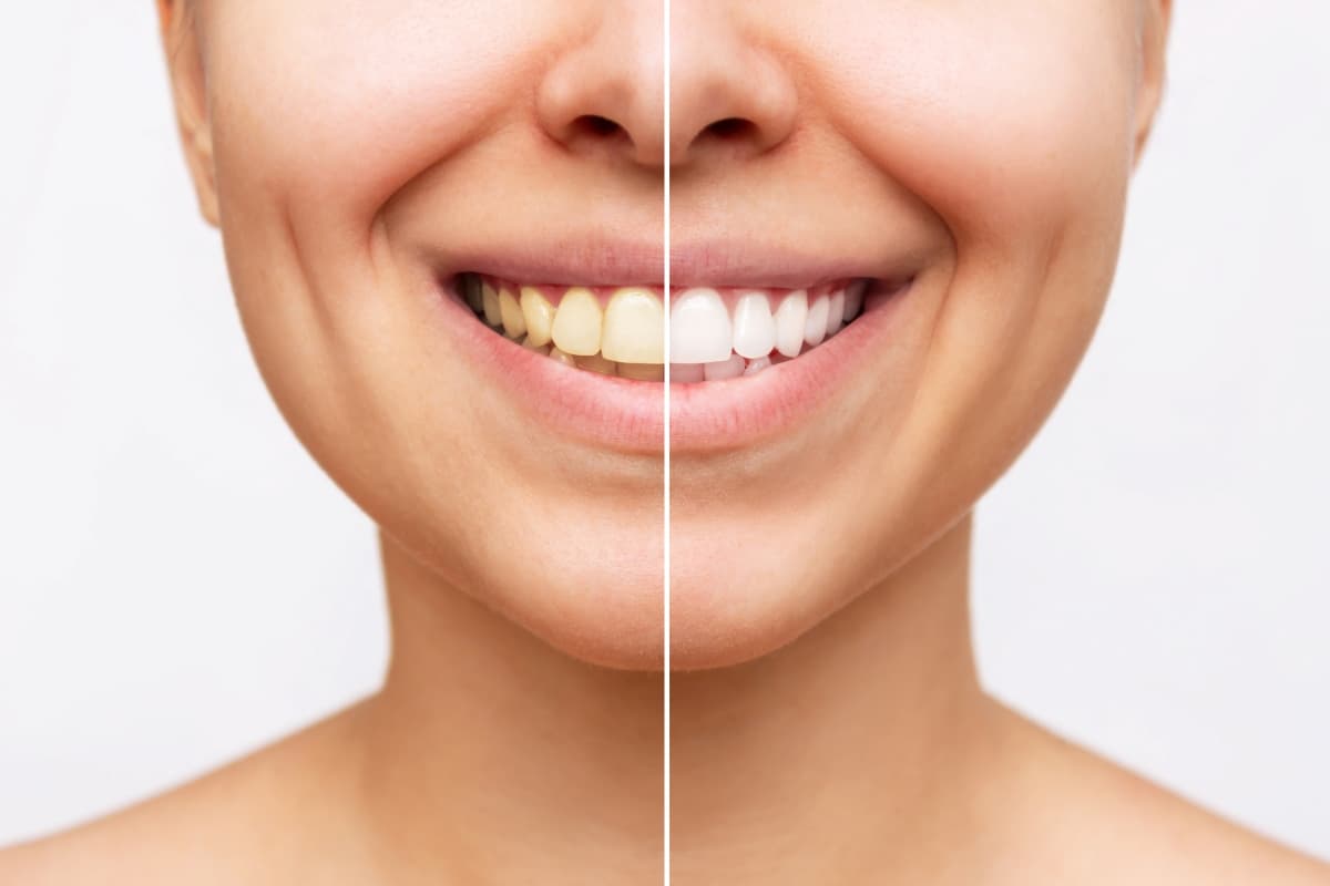 Why Does My Tooth Hurt When I Bite Down? A City Dentist Explains
