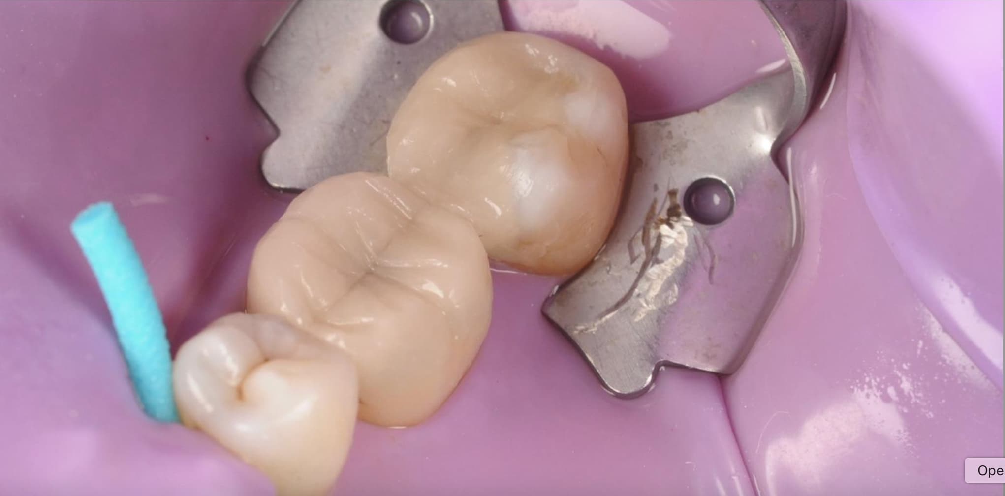 After White Fillings