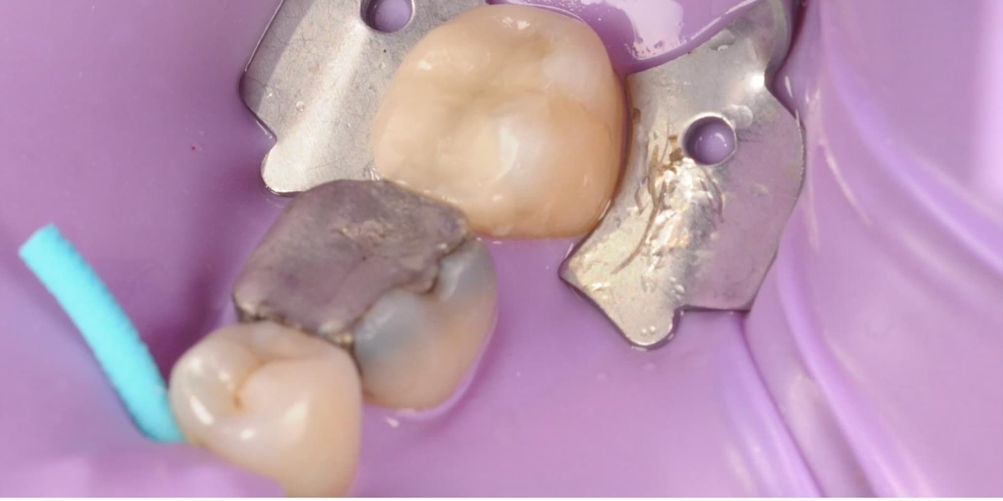 Before White Fillings