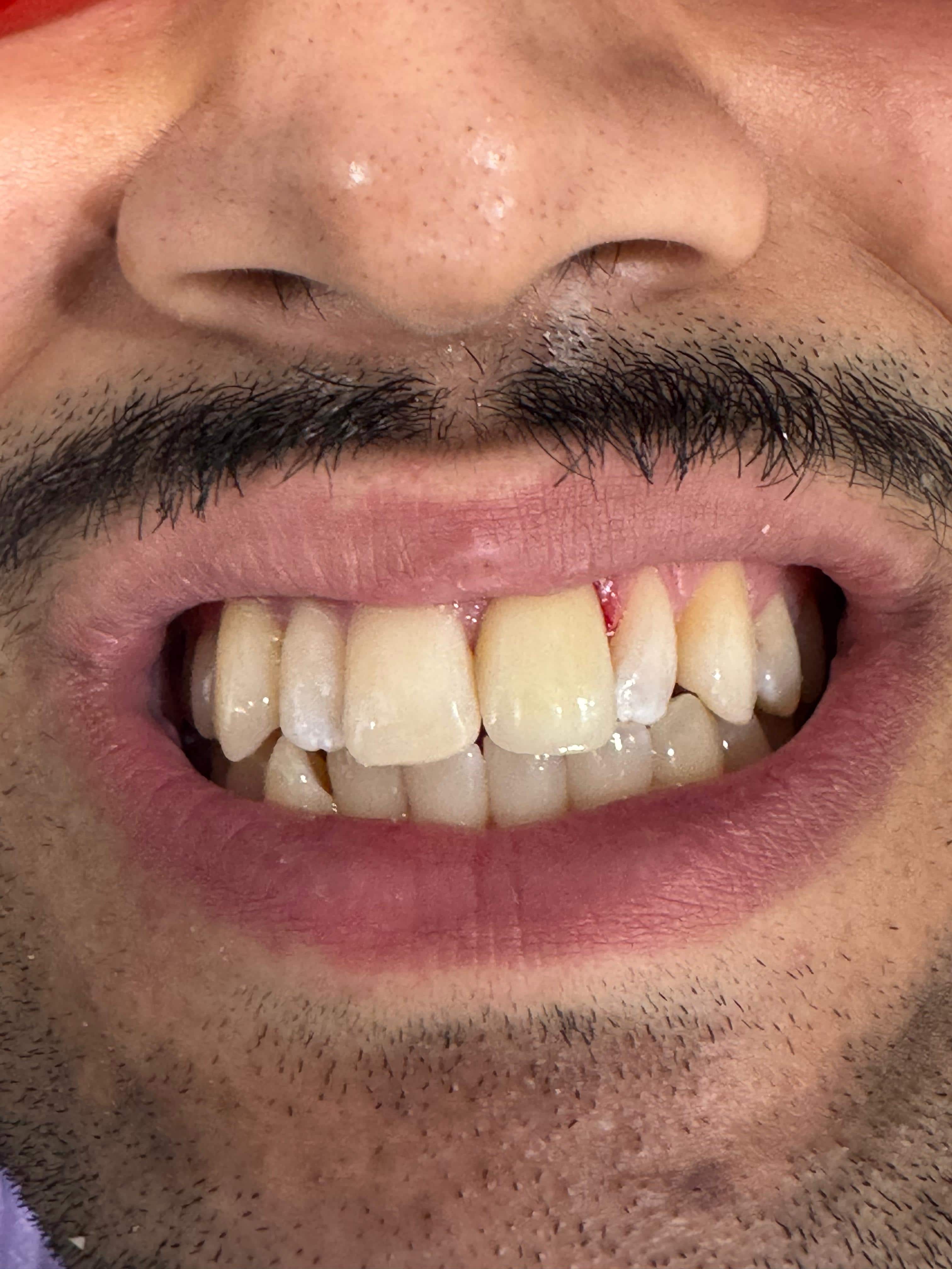After Emergency Root Canal & Crown