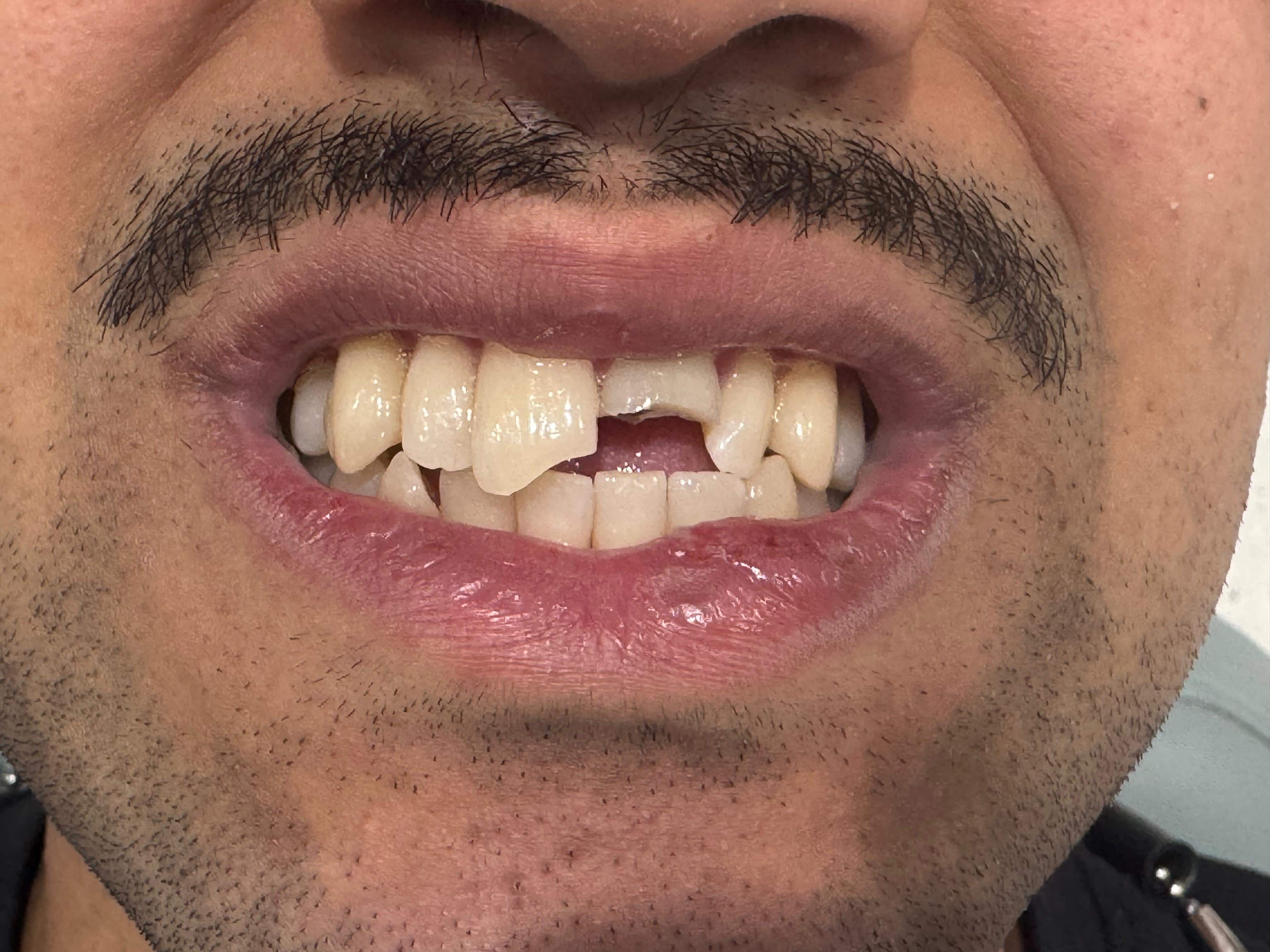 Before Emergency Root Canal & Crown