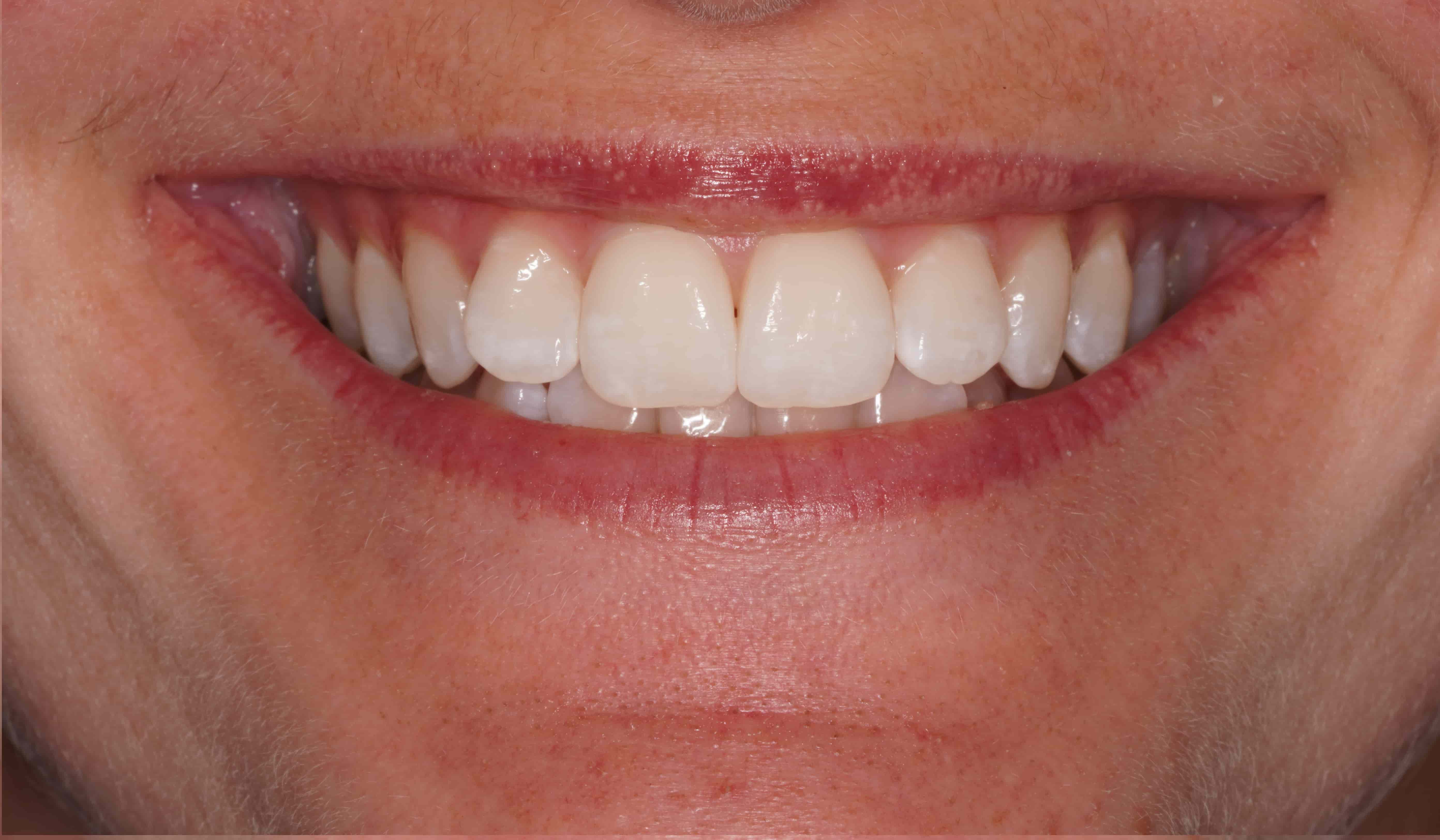 After Teeth Whitening