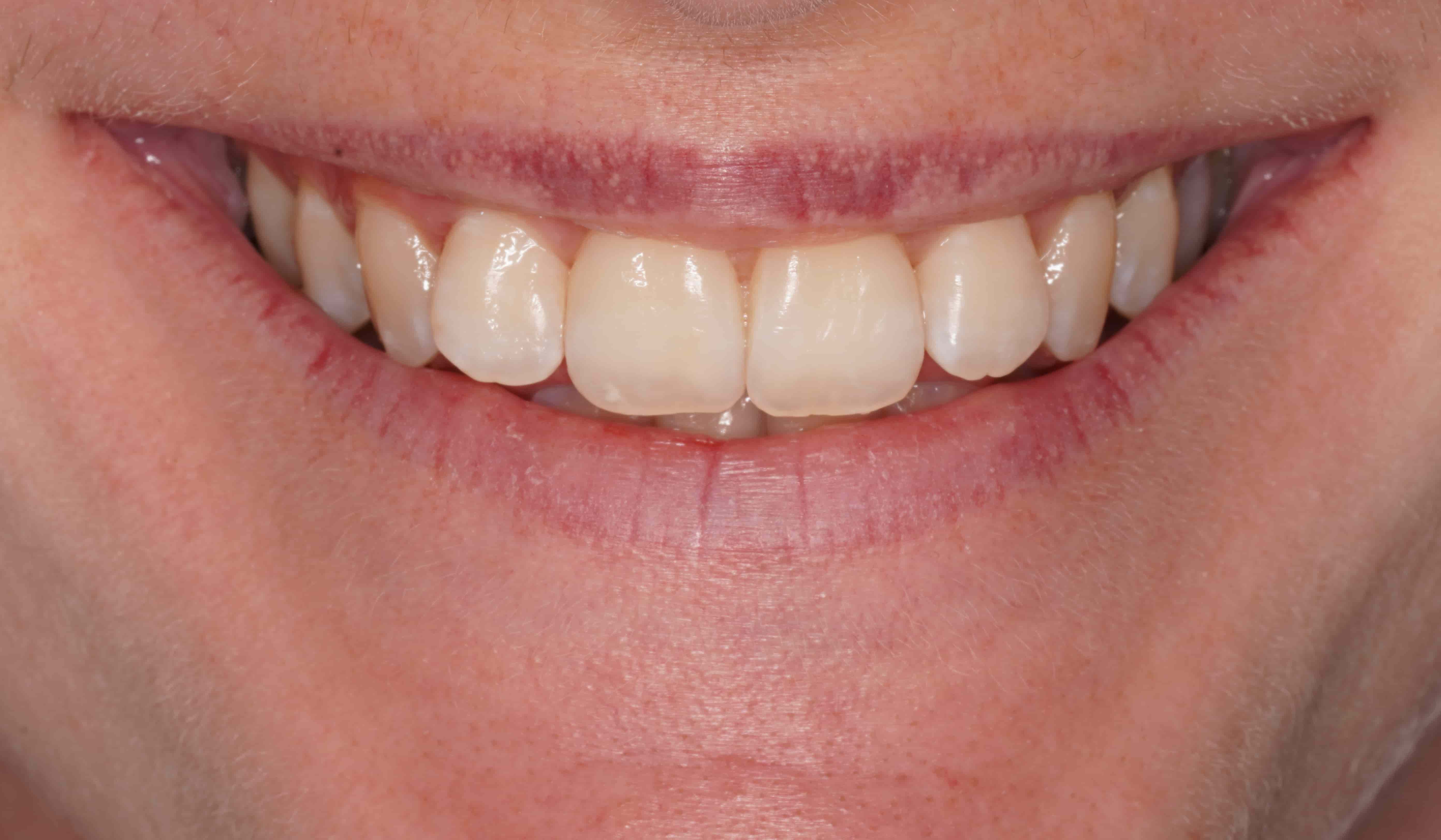 Before Teeth Whitening