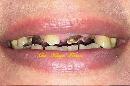 Before Composite Bonding